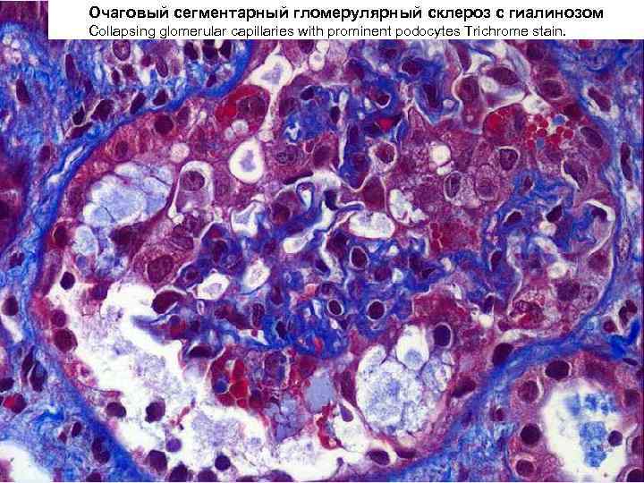 Очаговый сегментарный гломерулярный склероз с гиалинозом Collapsing glomerular capillaries with prominent podocytes Trichrome stain.