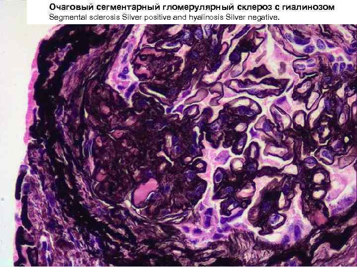 Очаговый сегментарный гломерулярный склероз с гиалинозом Segmental sclerosis Silver positive and hyalinosis Silver negative.