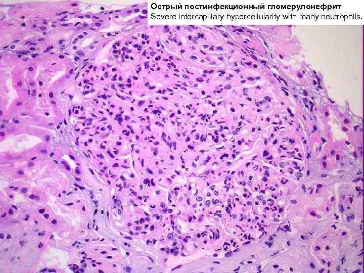 Острый постинфекционный гломерулонефрит Severe intercapillary hypercellularity with many neutrophils. 