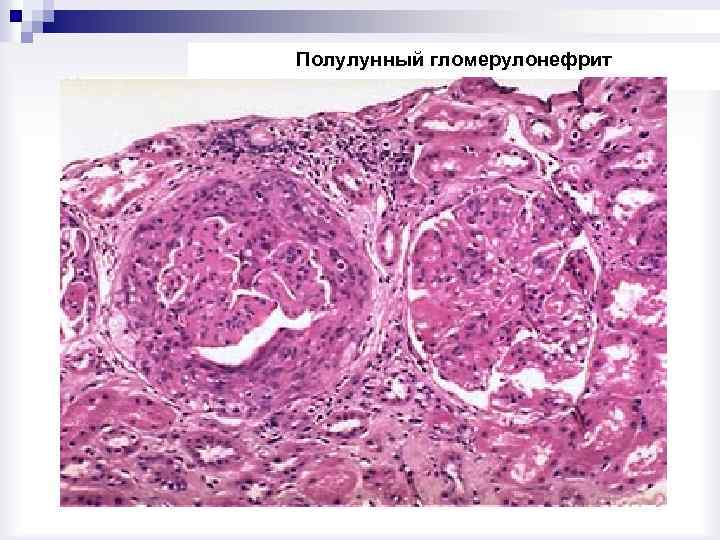 Полулунный гломерулонефрит 
