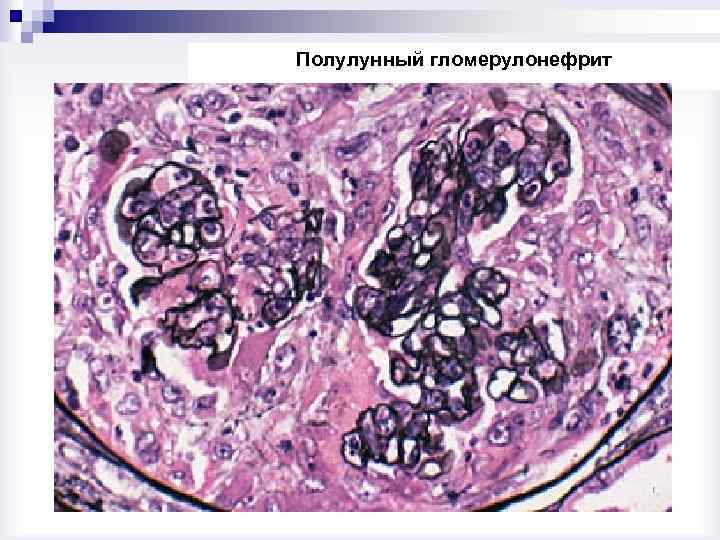 Полулунный гломерулонефрит 