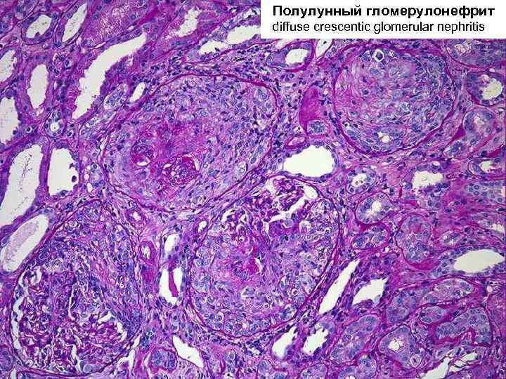 Полулунный гломерулонефрит diffuse crescentic glomerular nephritis 