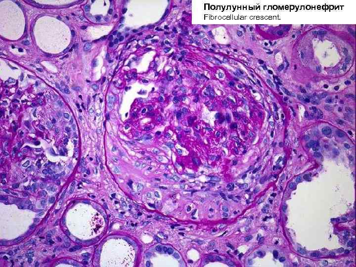 Полулунный гломерулонефрит Fibrocellular crescent. 