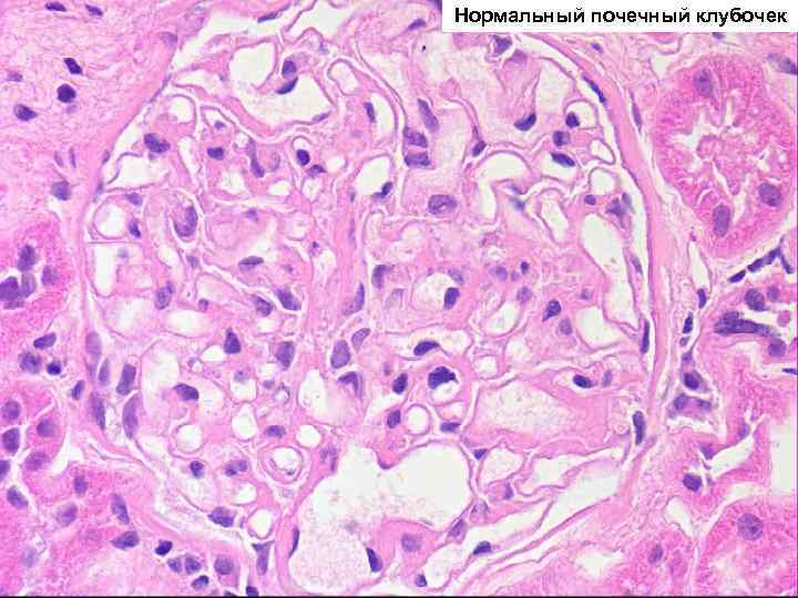Нормальный почечный клубочек 