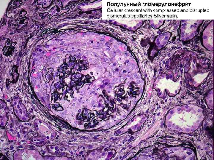 Полулунный гломерулонефрит Cellular crescent with compressed and disrupted glomerulus capillaries Silver stain. 