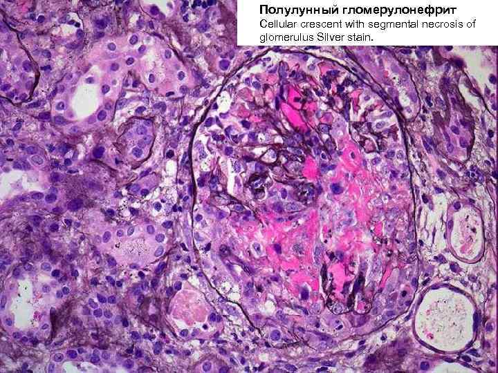Полулунный гломерулонефрит Cellular crescent with segmental necrosis of glomerulus Silver stain. 