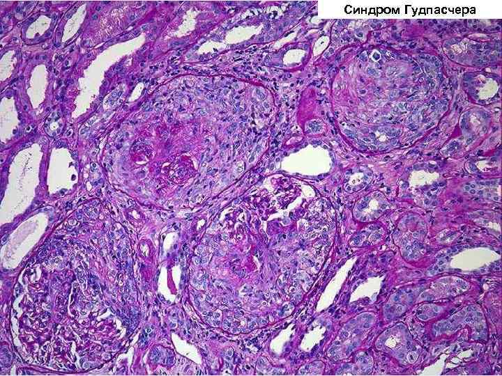 Синдром Гудпасчера 
