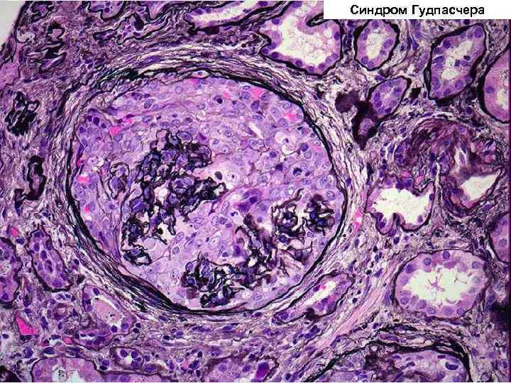 Синдром Гудпасчера 