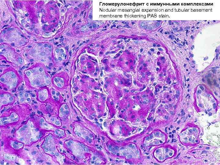 Гломерулонефрит с иммунными комплексами Nodular mesangial expansion and tubular basement membrane thickening PAS stain.