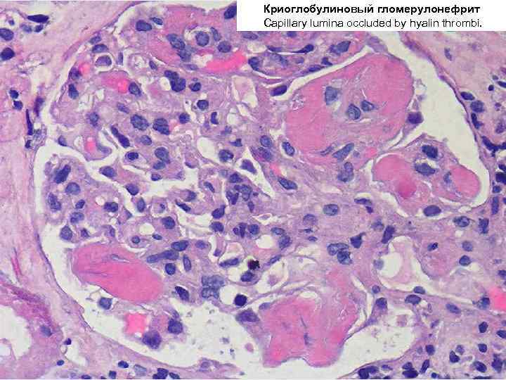 Криоглобулиновый гломерулонефрит Capillary lumina occluded by hyalin thrombi. 