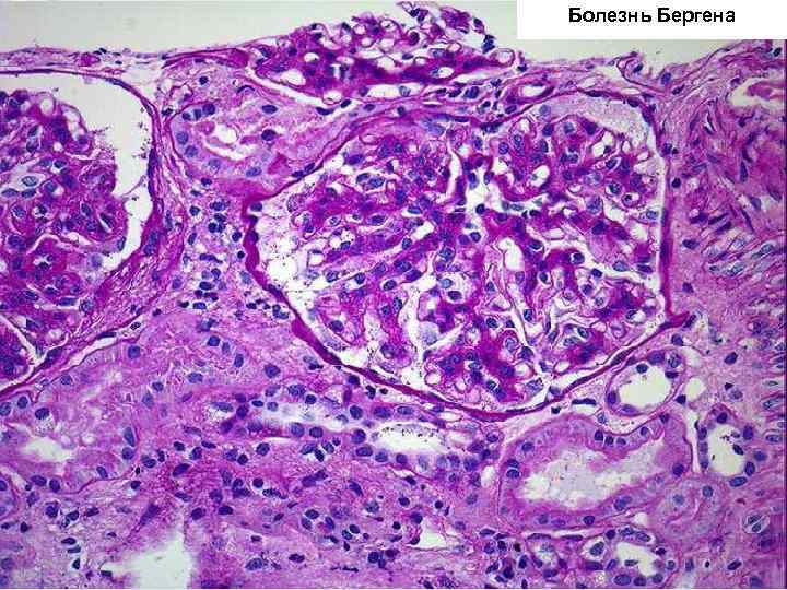 Болезнь Бергена 