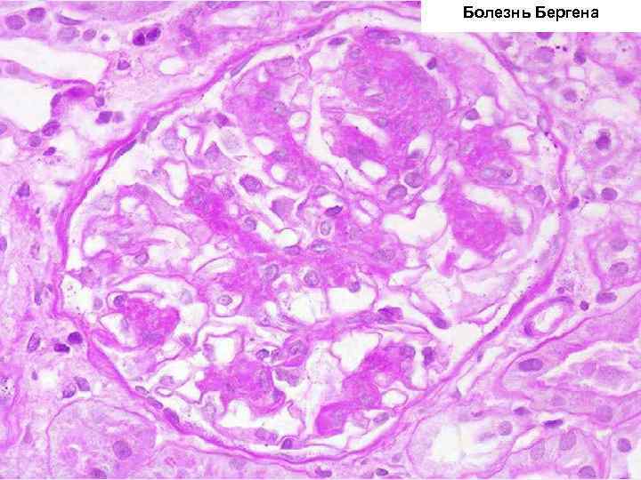 Болезнь Бергена 