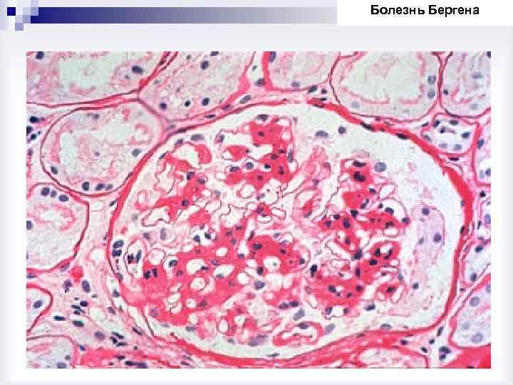 Болезнь Бергена 