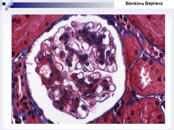 Болезнь Бергена 
