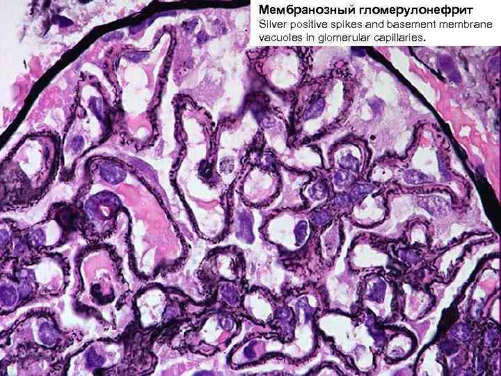 Хронический гломерулонефрит микроскопическая картина