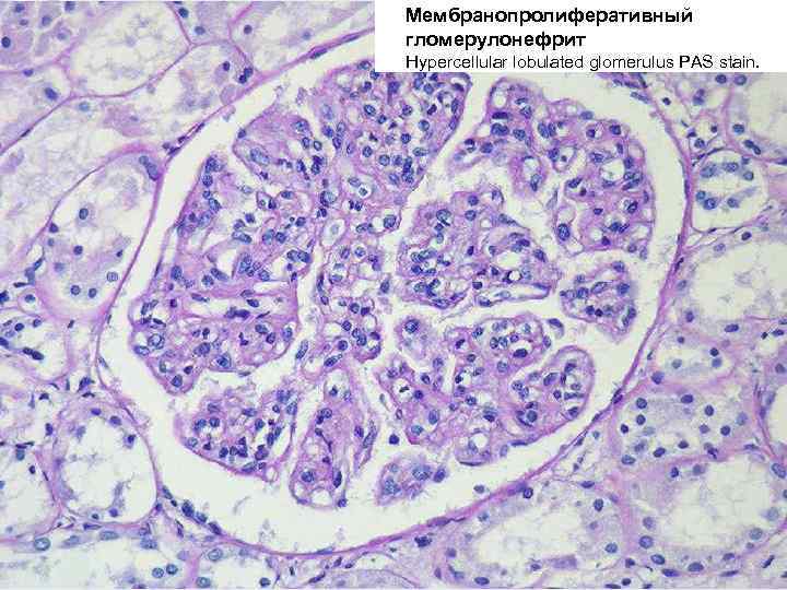 Морфологическая картина гломерулонефрита
