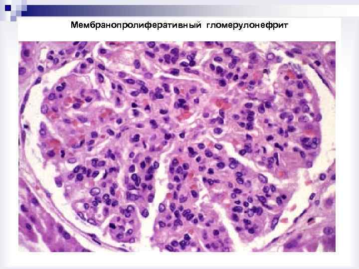 Морфологическая картина гломерулонефрита