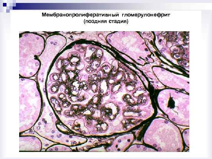Острый гломерулонефрит микроскопическая картина