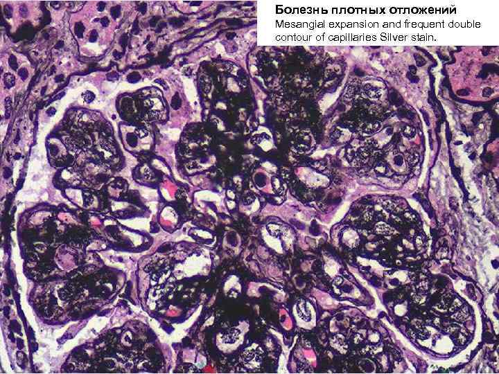 Болезнь плотных отложений Mesangial expansion and frequent double contour of capillaries Silver stain. 