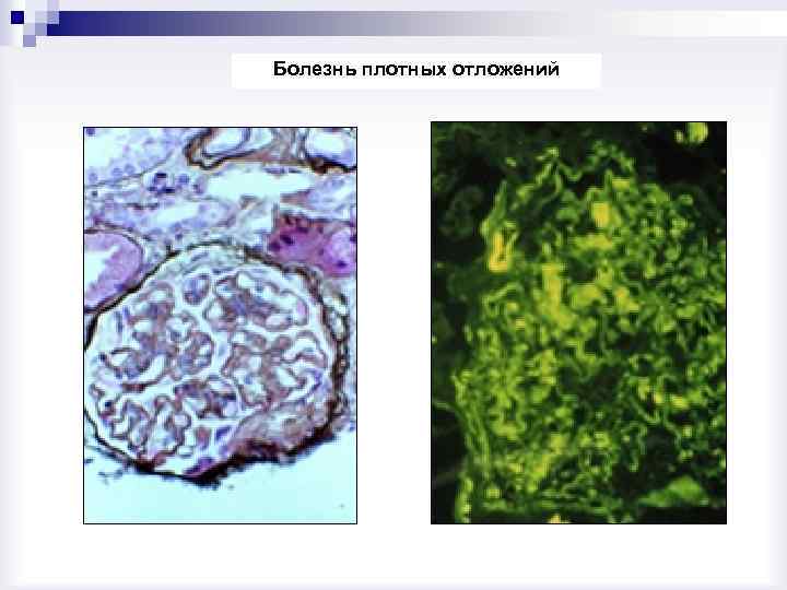 Болезнь плотных отложений 