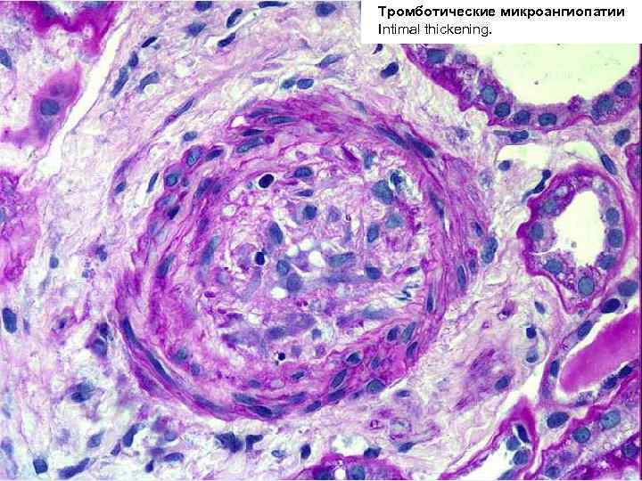 Тромботические микроангиопатии ДВС-синдром Intimal thickening. 