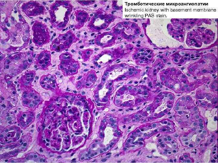 Тромботические микроангиопатии ДВС-синдром Ischemic kidney with basement membrane wrinkling PAS stain. 