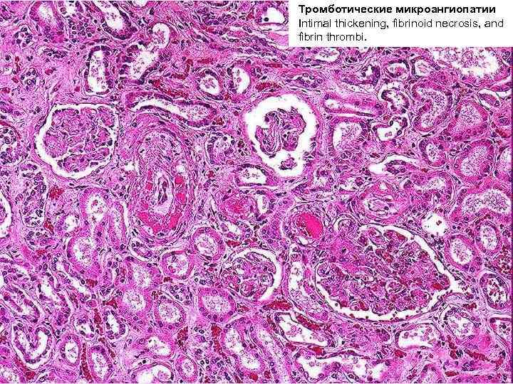 Тромботические микроангиопатии ДВС-синдром Intimal thickening, fibrinoid necrosis, and fibrin thrombi. 