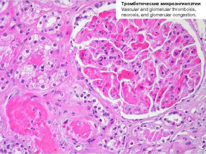 Тромботические микроангиопатии ДВС-синдром Vascular and glomerular thrombosis, necrosis, and glomerular congestion. 