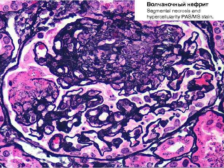Волчаночный нефрит Segmental necrosis and hypercellularity PAS/MS stain. 