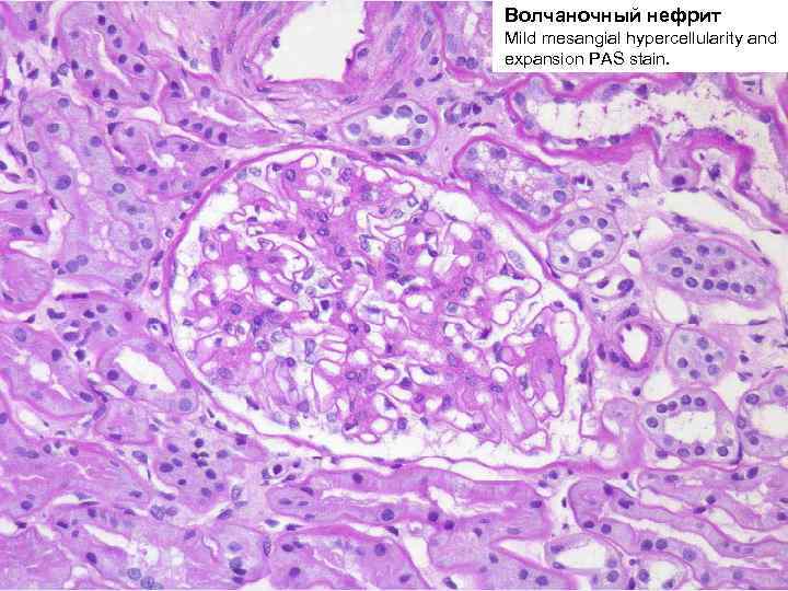 Волчаночный нефрит Mild mesangial hypercellularity and expansion PAS stain. 