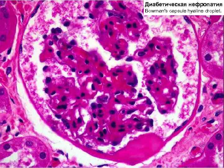 Диабетическая нефропатия Bowman's capsule hyaline droplet. 