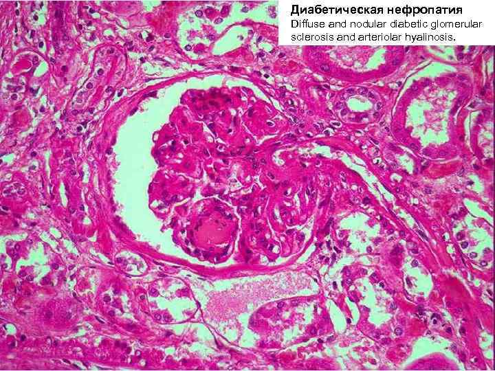 Диабетическая нефропатия Diffuse and nodular diabetic glomerular sclerosis and arteriolar hyalinosis. 