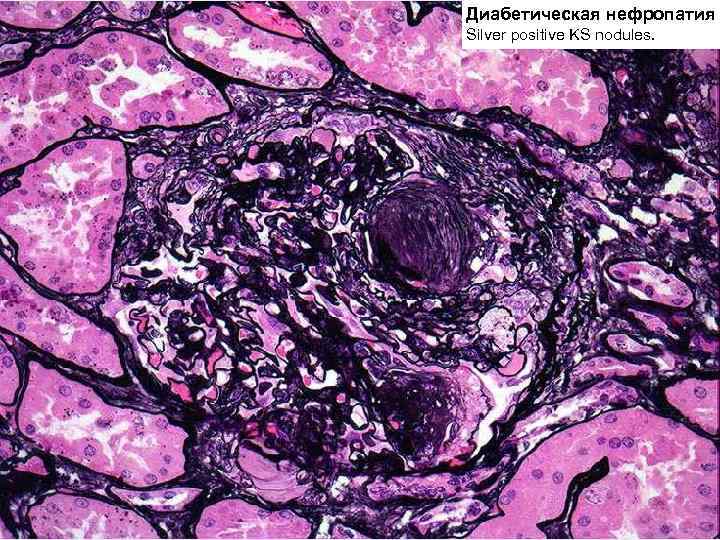 Диабетическая нефропатия Silver positive KS nodules. 
