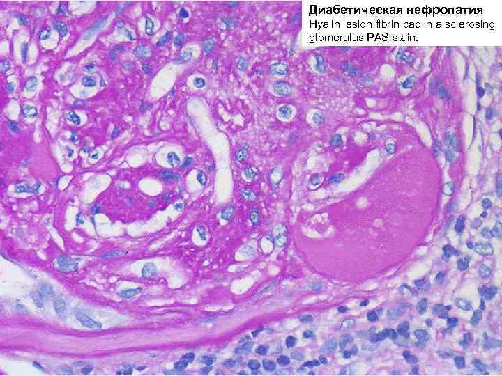 Диабетическая нефропатия Hyalin lesion fibrin cap in a sclerosing glomerulus PAS stain. 