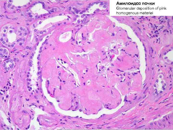 Амилоидоз почки Glomerular deposition of pink homogenous material 