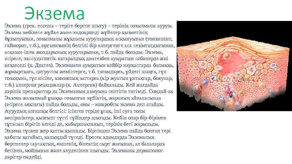 Экзема (грек. eczema – теріге бөртпе шығу) – терінің созылмалы ауруы. Экзема көбінесе жүйке