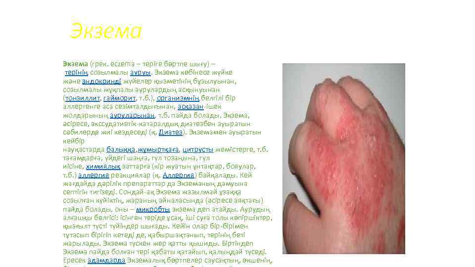 Экзема (грек. eczema – теріге бөртпе шығу) – терінің созылмалы ауруы. Экзема көбінесе жүйке
