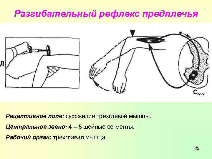 Разгибательный рефлекс предплечья Рецептивное поле: сухожилие трехглавой мышцы. Центральное звено: 4 – 5 шейные