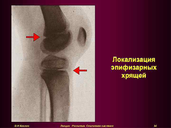 Локализация эпифизарных хрящей В. И. Козлов Лекция: Развитие. Скелетная система 34 
