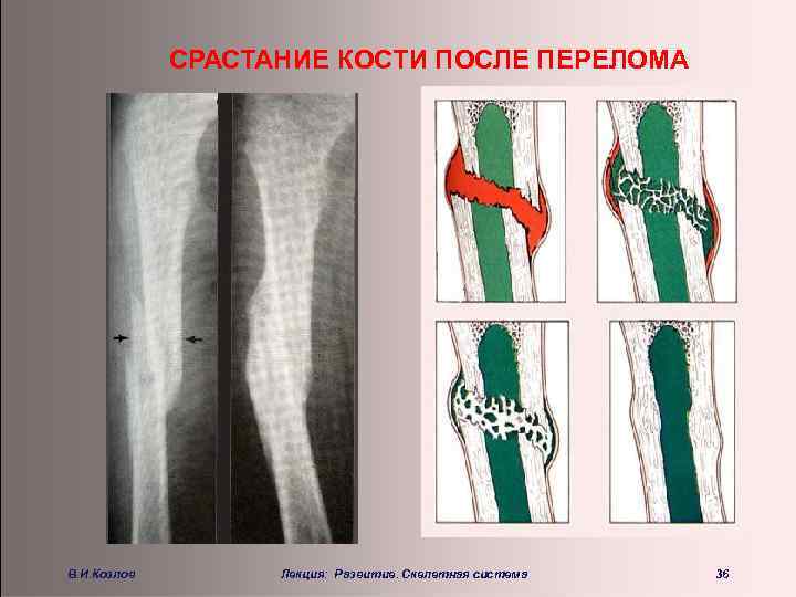 СРАСТАНИЕ КОСТИ ПОСЛЕ ПЕРЕЛОМА В. И. Козлов Лекция: Развитие. Скелетная система 36 