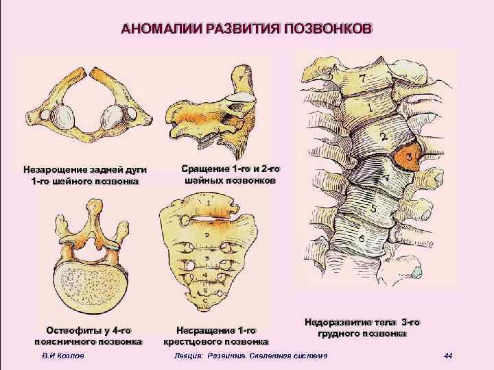 Задние остеофиты позвонков