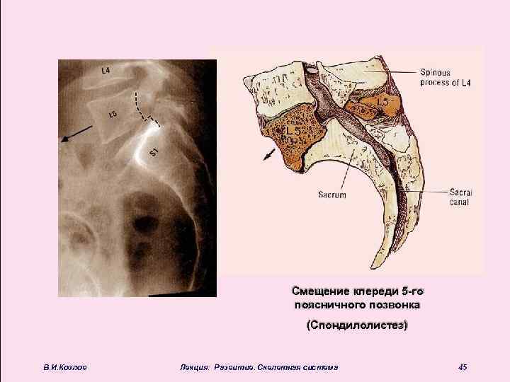 Смещение кпереди 5 -го поясничного позвонка (Спондилолистез) В. И. Козлов Лекция: Развитие. Скелетная система
