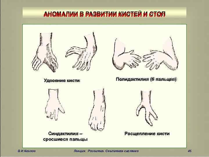 Аномалии развития верхних конечностей презентация