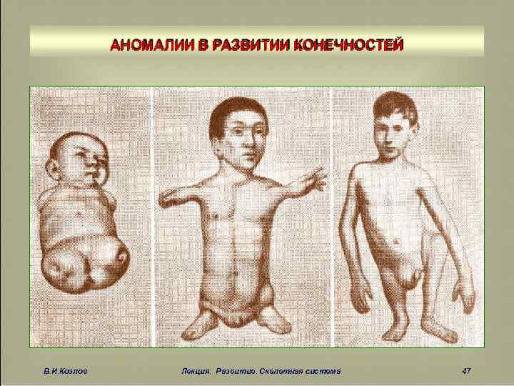 АНОМАЛИИ В РАЗВИТИИ КОНЕЧНОСТЕЙ В. И. Козлов Лекция: Развитие. Скелетная система 47 
