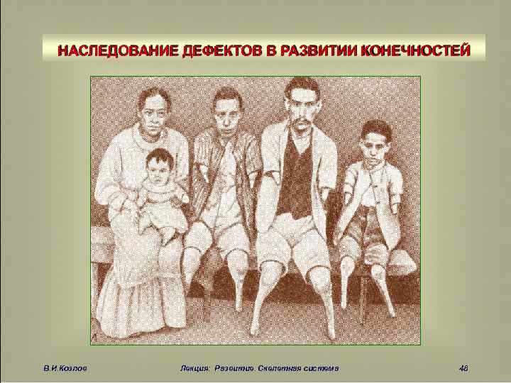 НАСЛЕДОВАНИЕ ДЕФЕКТОВ В РАЗВИТИИ КОНЕЧНОСТЕЙ В. И. Козлов Лекция: Развитие. Скелетная система 48 