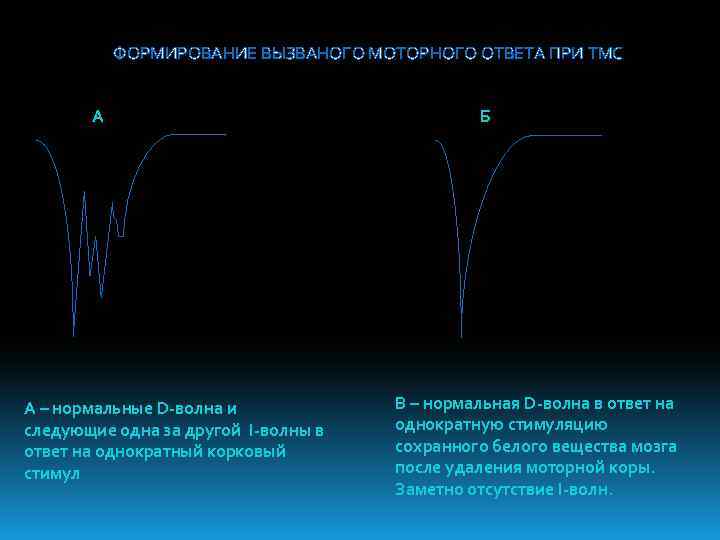 ФОРМИРОВАНИЕ ВЫЗВАНОГО МОТОРНОГО ОТВЕТА ПРИ ТМС А А – нормальные D-волна и следующие одна