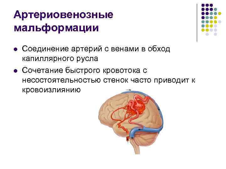 Артериовенозные мальформации l l Соединение артерий с венами в обход капиллярного русла Сочетание быстрого
