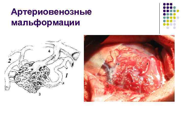 Артериовенозные мальформации 