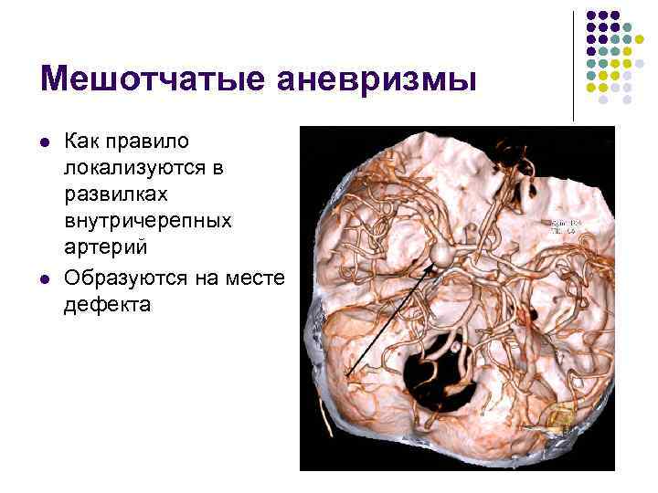 Мешотчатые аневризмы l l Как правило локализуются в развилках внутричерепных артерий Образуются на месте