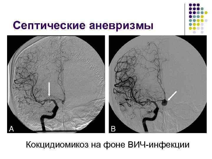 Септические аневризмы Кокцидиомикоз на фоне ВИЧ-инфекции 